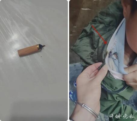 6岁男童棉衣烧出个大窟窿